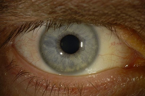 แพทย์อเมริกันดวงตาเปลี่ยนสี หลังติดเชื้ออีโบลา