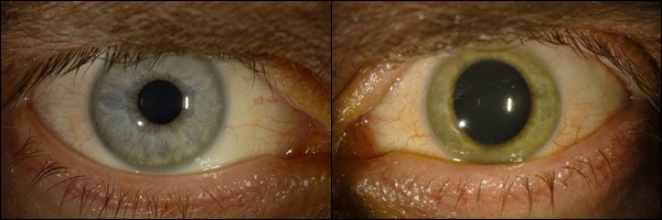 แพทย์อเมริกันดวงตาเปลี่ยนสี หลังติดเชื้ออีโบลา 