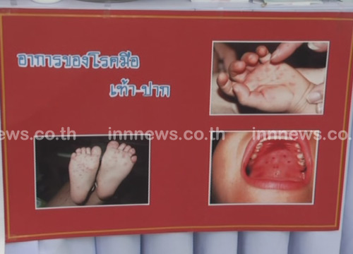 ผอ.สำนักระบาดวิทยา ยันเด็ก 2 ปี ตายเพราะโรคมือ เท้า ปาก 