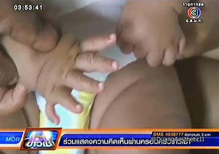 น้องเนย วัย 6 เดือน มีนิ้วมือ-นิ้วเท้า รวม 24 นิ้ว